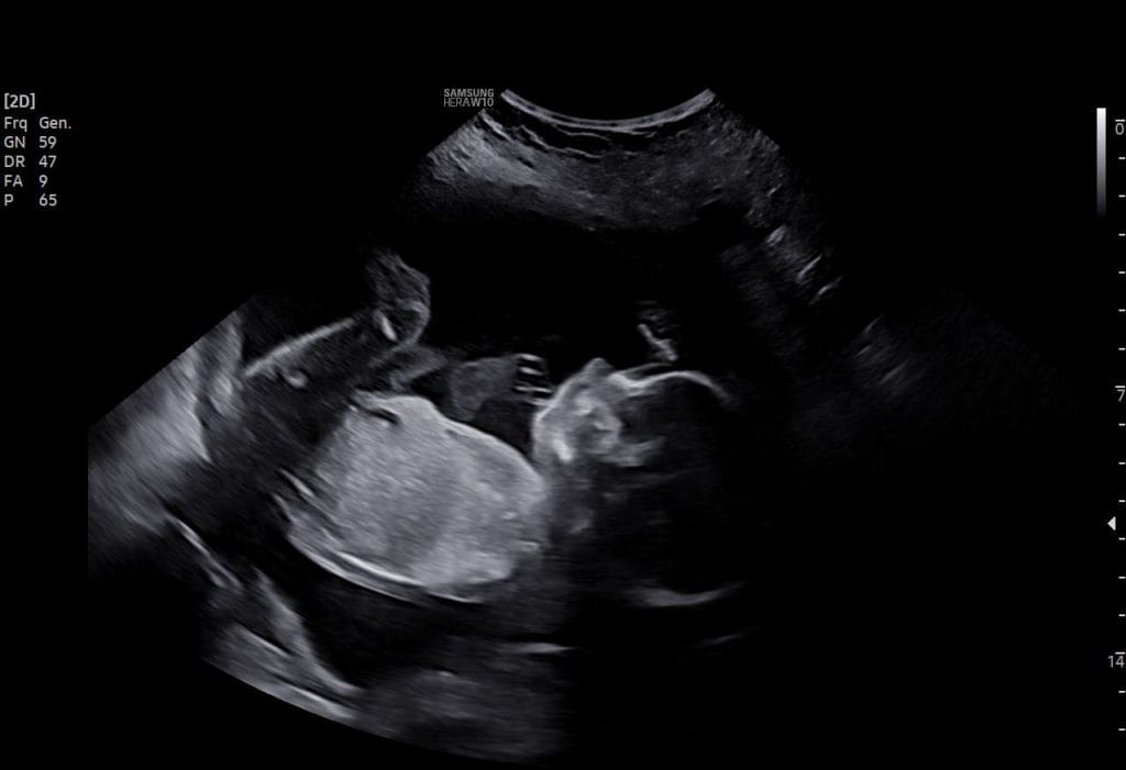 Morgan and Jeremy's First Kid's Ultrasound
